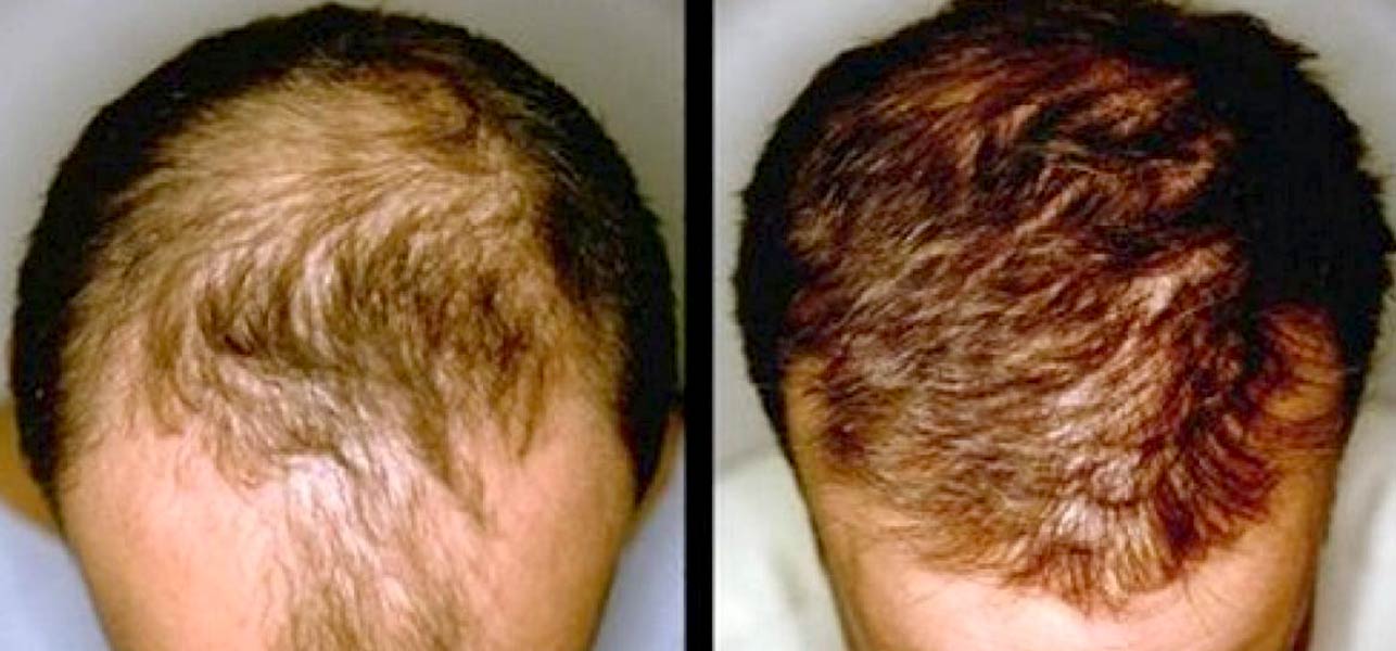 can dormant hair follicles regrow